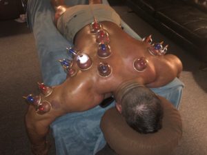 Best Cupping Massage Therapy in Rancho Cucamonga Photo